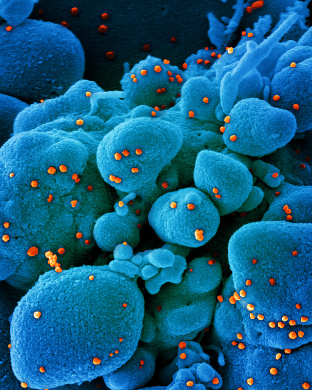 感染sars-cov-2病毒颗粒(橙色)的凋亡细胞扫描电镜染色(蓝色).图片