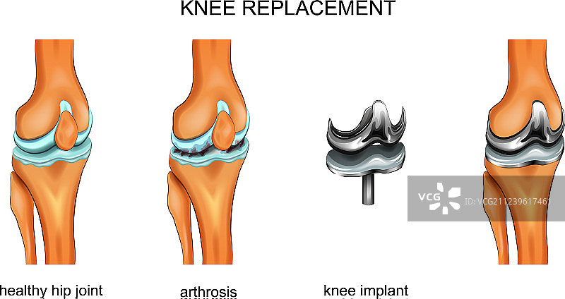 膝关节endoprosthesis图片素材
