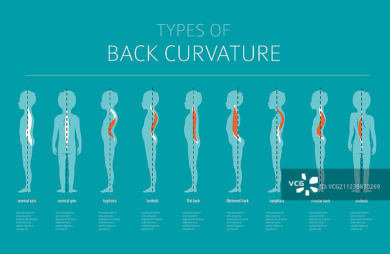 背部弯曲疾病的类型图片素材