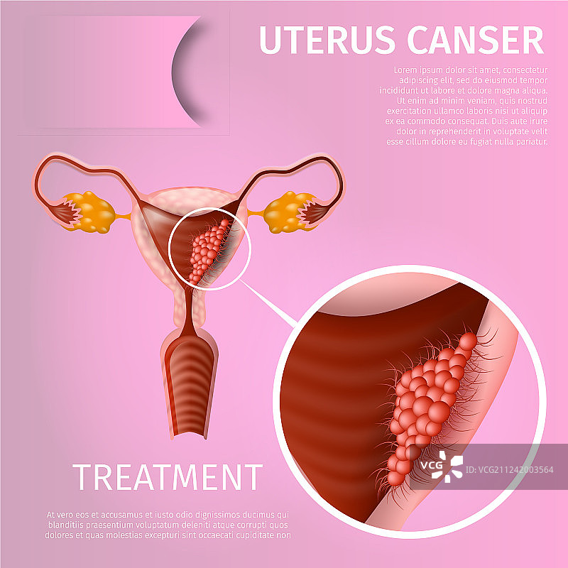 子宫癌肿瘤细胞图图片素材