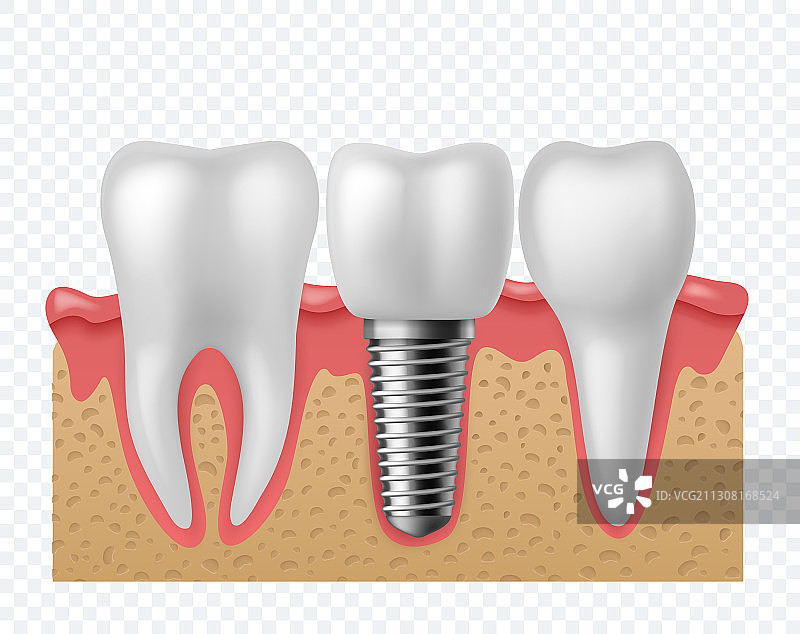 牙齿种植人类牙齿和牙齿种植图片素材