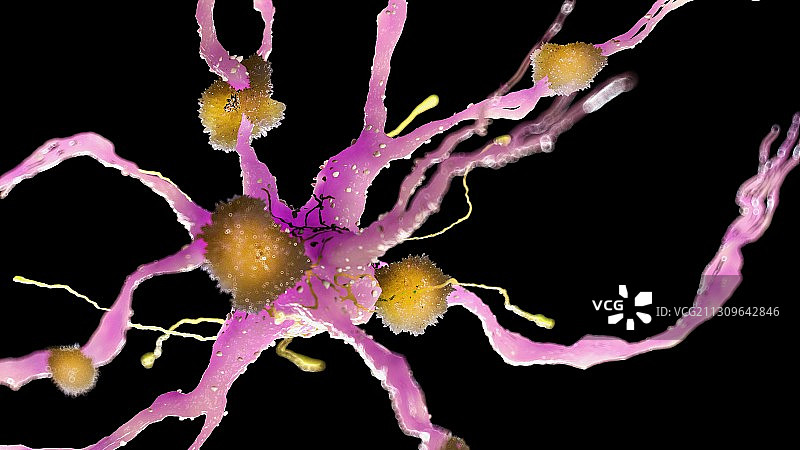 神经细胞上的淀粉样斑块图片素材