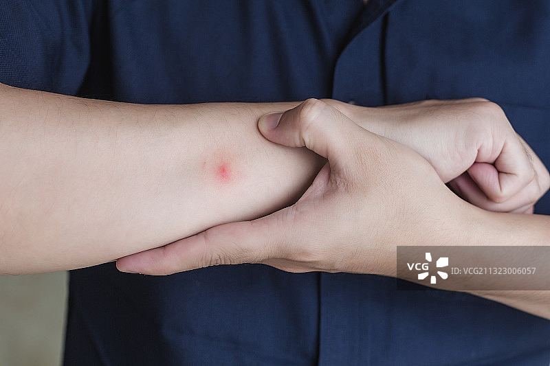 亚洲男性手臂被蚊虫叮咬的红包。图片素材