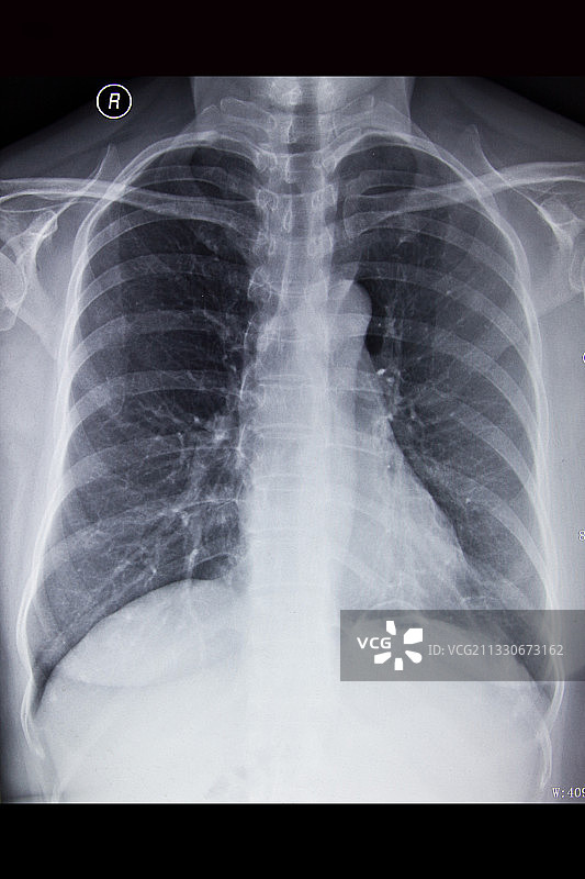 医学DR摄影X射线胶片影像图图片素材