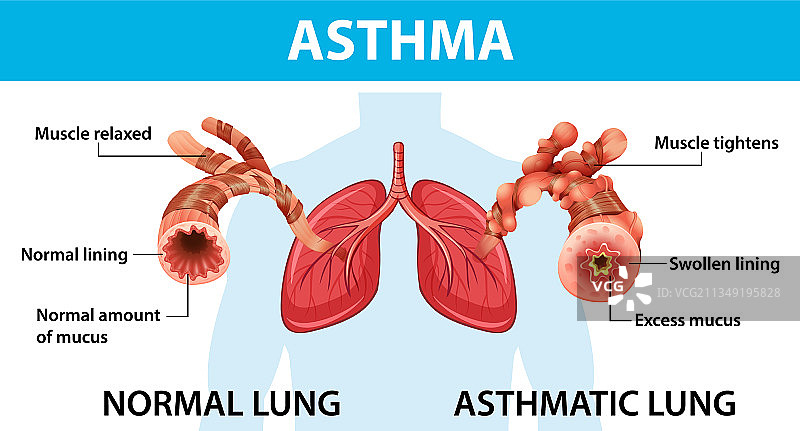 正常肺和哮喘肺的哮喘图图片素材