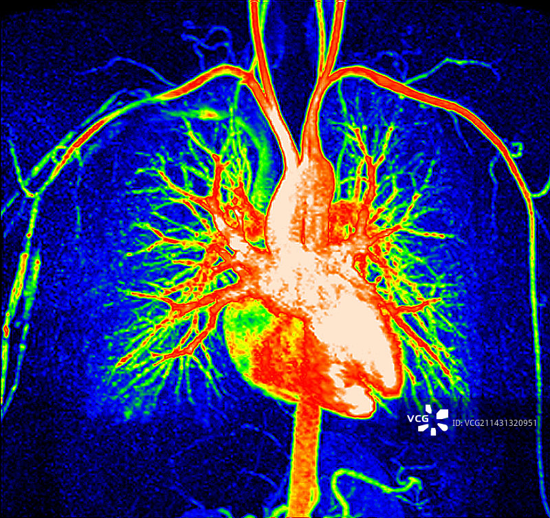 健康的心脏和血管，核磁共振血管造影图片素材