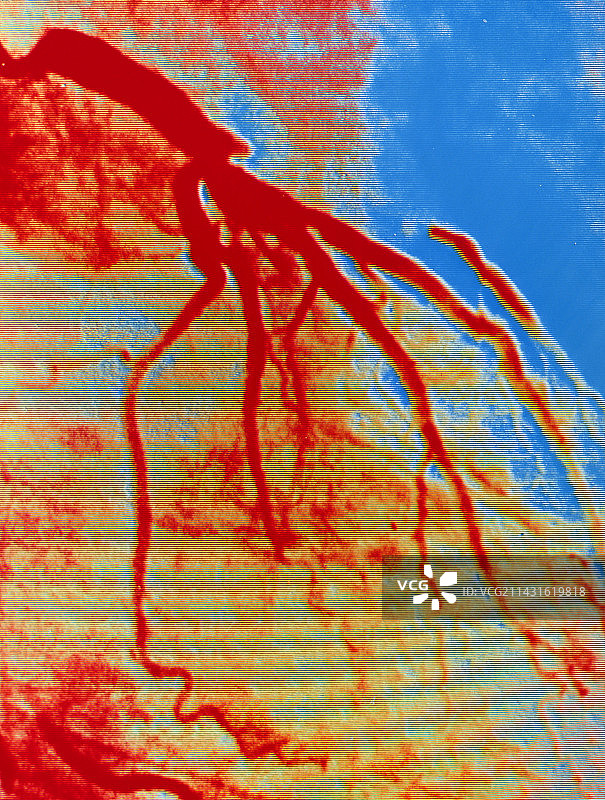 冠状动脉阻塞的F/col血管造影图片素材