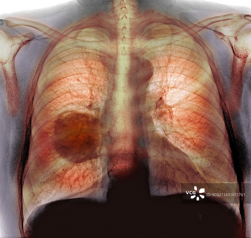 肺癌，x光检查图片素材