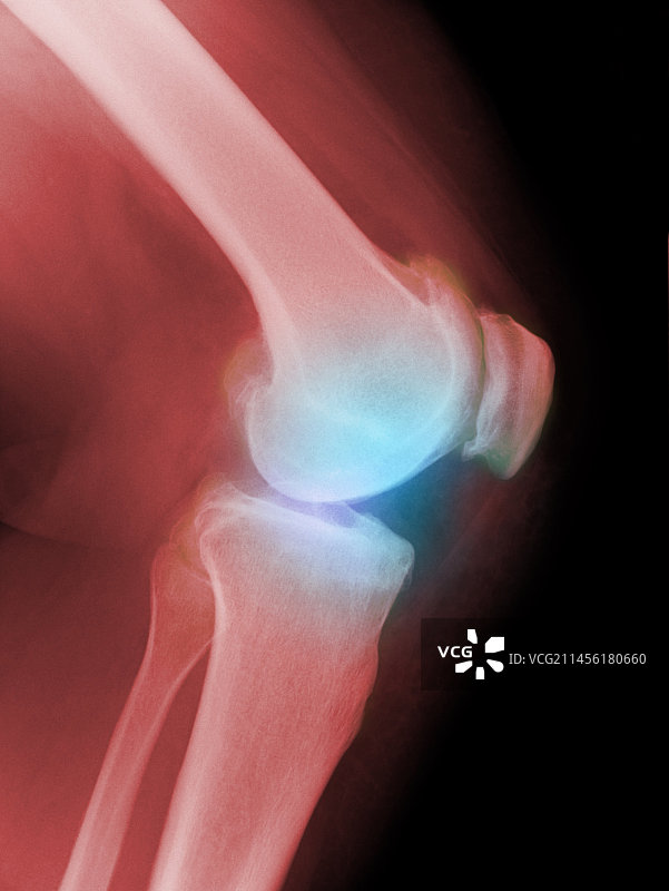 膝关节关节炎，x光片图片素材