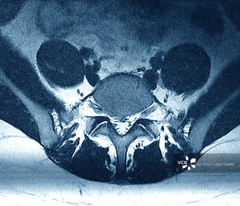 坐骨神经痛椎间盘突出，MRI图片素材