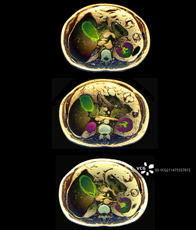 胆囊炎症，轴位CT扫描图片素材