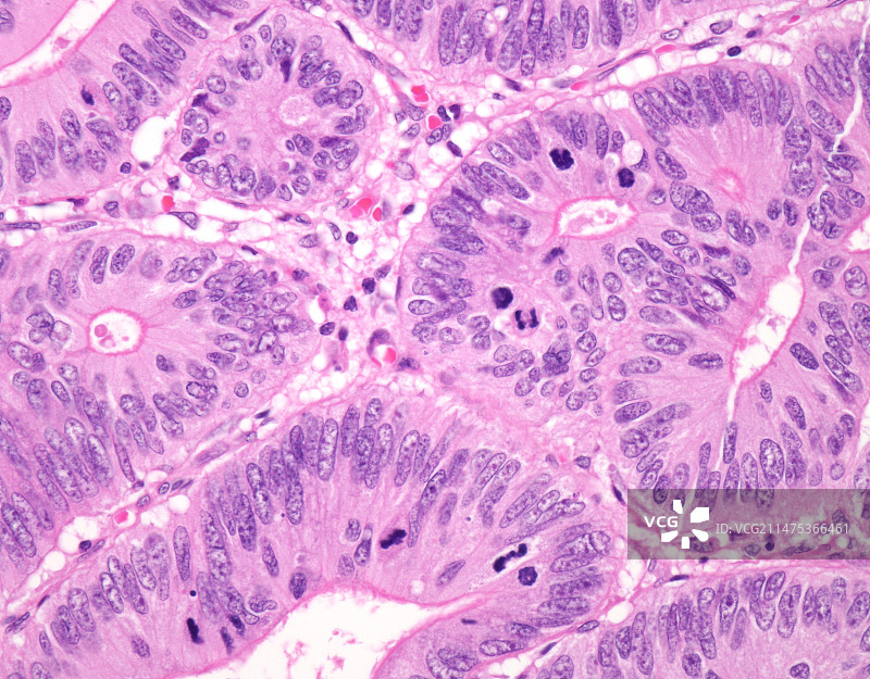 息肉中的结肠癌，光镜照片图片素材