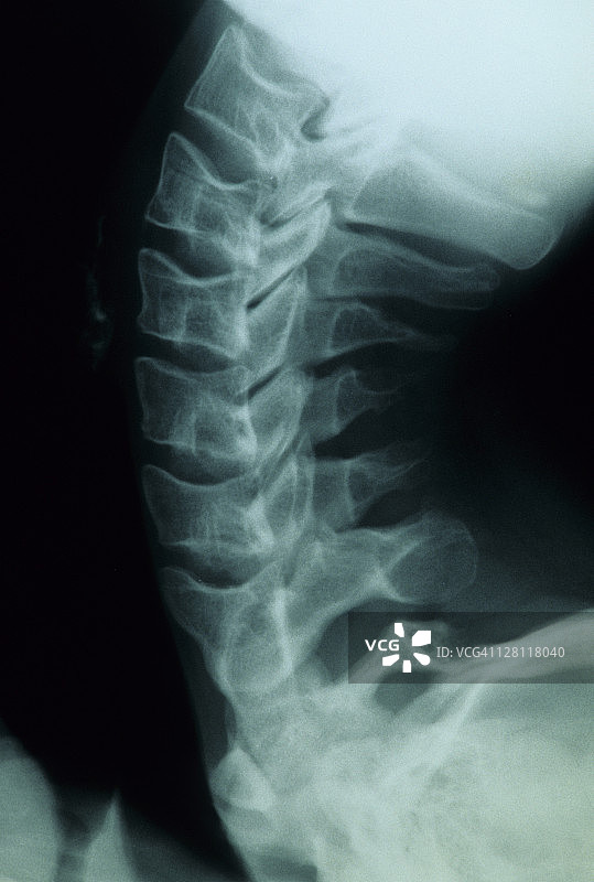 颈椎x线片，侧位片，颈部过伸。显示:椎体、棘突、关节突椎间盘(间隙)。图片素材