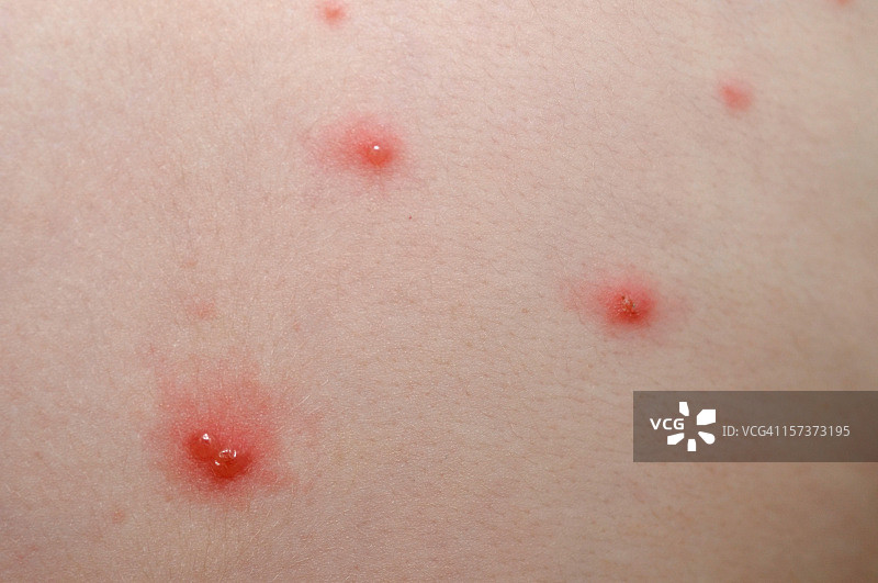 水痘——疾病图片素材