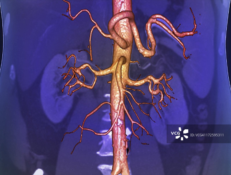 腹主动脉，3D CT扫描图片素材