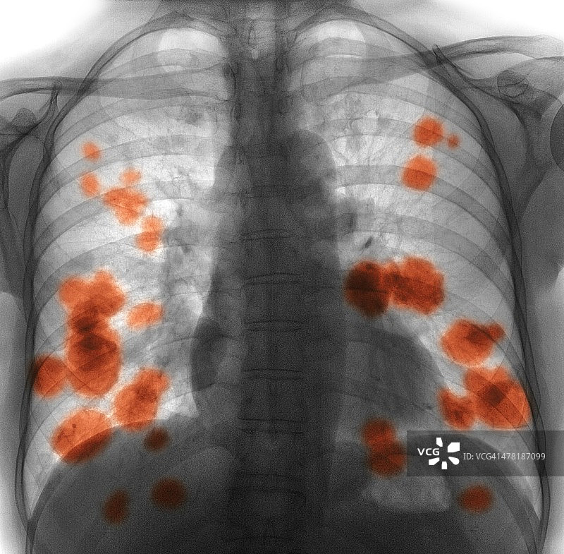 继发性肺癌，x线图片素材