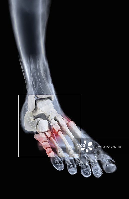 前角x光片显示右脚跖骨多处骨折。图片素材