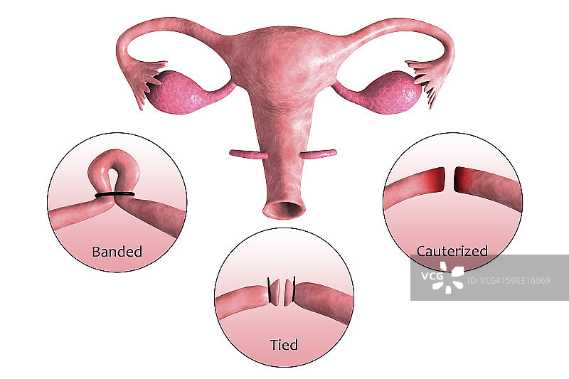 输卵管切除术的生物医学插图。图片素材