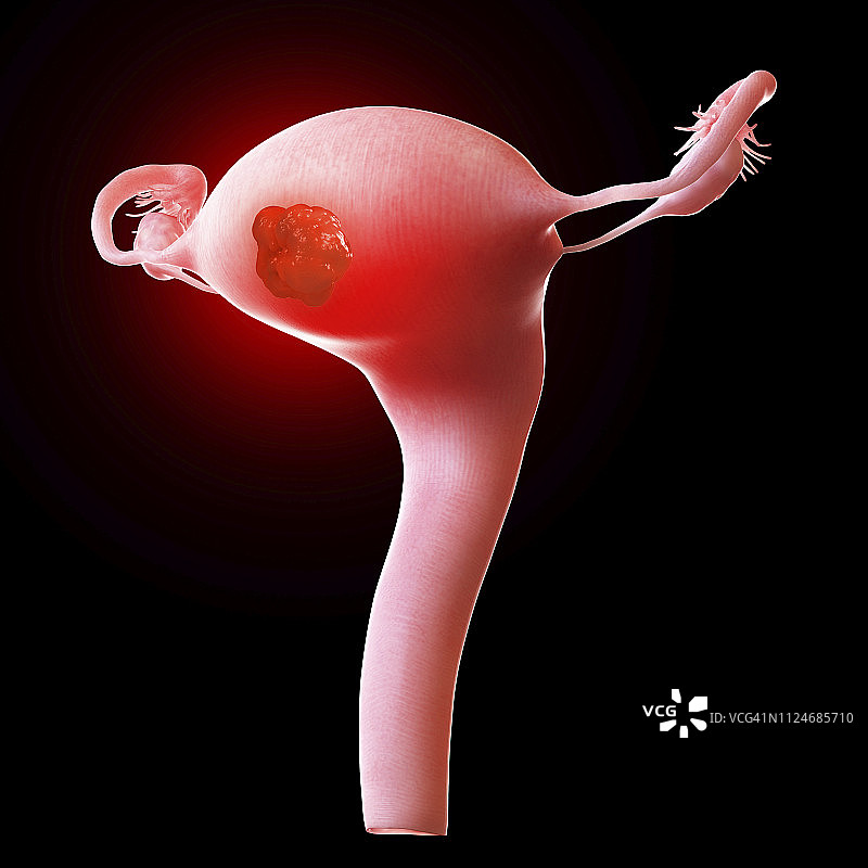 图示:子宫肿瘤图片素材