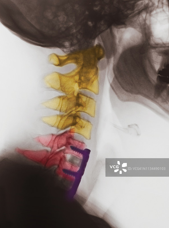 颈部x光片显示脊柱融合图片素材