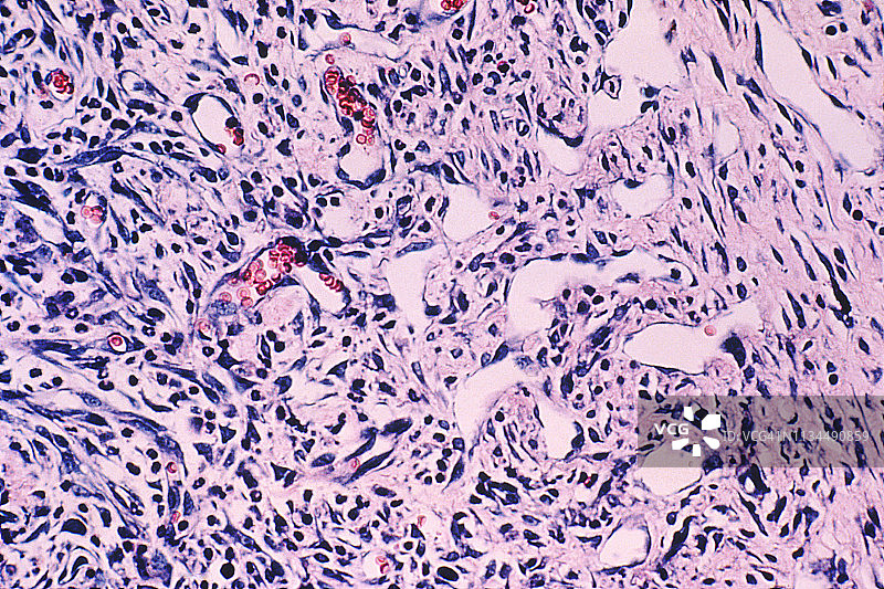 卡波西肉瘤的光学显微镜照片图片素材