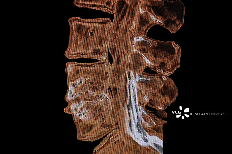 MRI脊柱影像侧视图图片素材