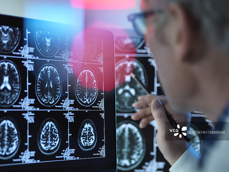 医生在看脑部扫描，以确定可能的疾病或损伤图片素材