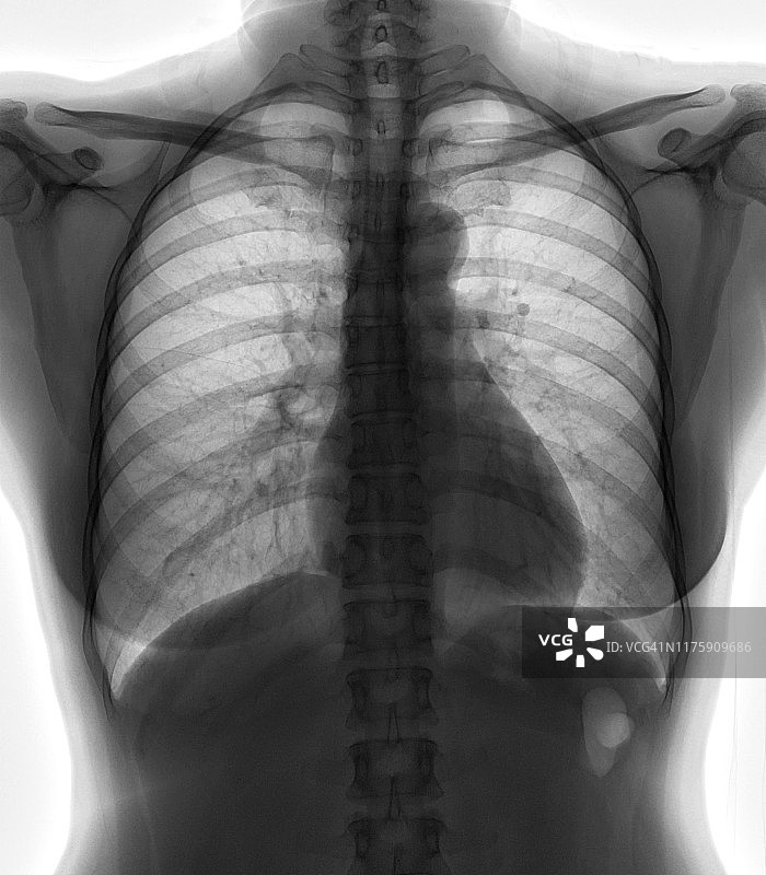 x线胸片胸部PA直立，肺正常。图片素材