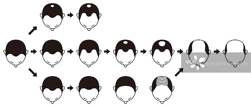 信息图表的脱发阶段和类型的秃顶说明在一个男性的头部。图片素材