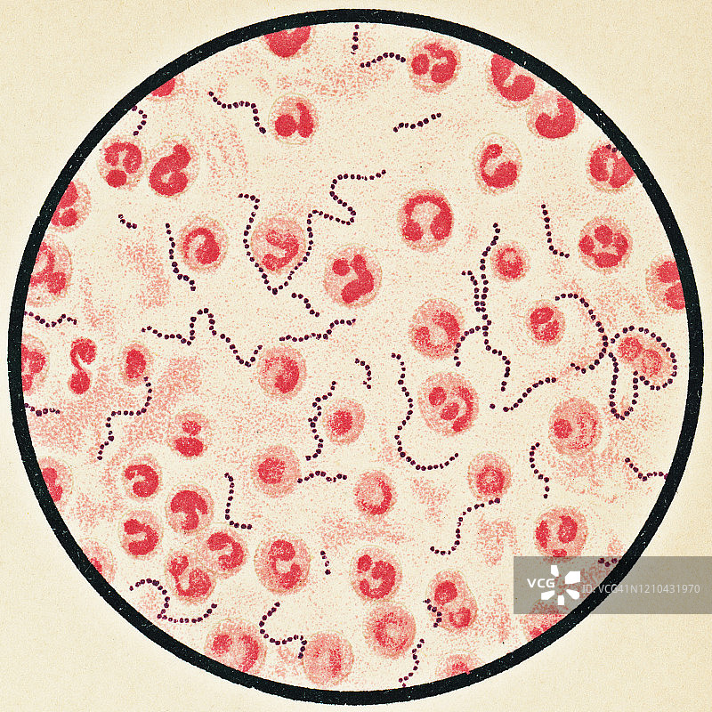 人类血细胞和化脓性链球菌细菌的显微镜观察，从患者发展了a组链球菌感染的肺炎- 19世纪图片素材
