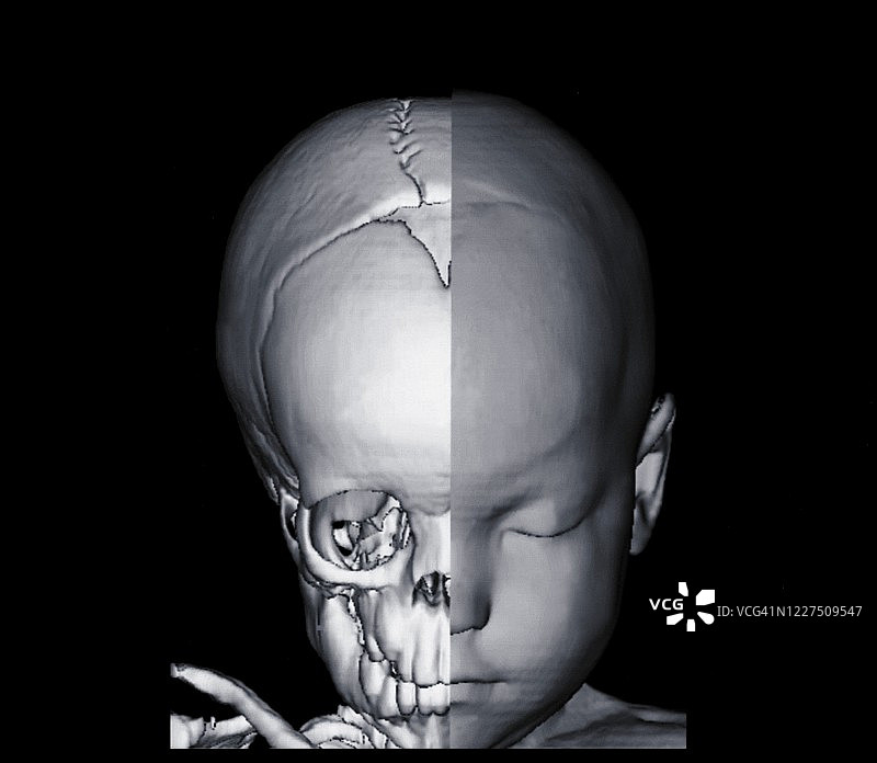 婴儿头部和半颅骨图像，CT扫描图片素材