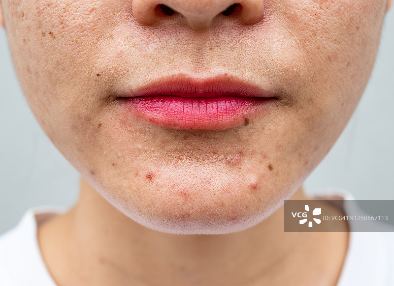 亚洲女性的半脸特写有各种各样的皮肤问题(如痤疮，丘疹，毛孔和黄褐斑等)。图片素材