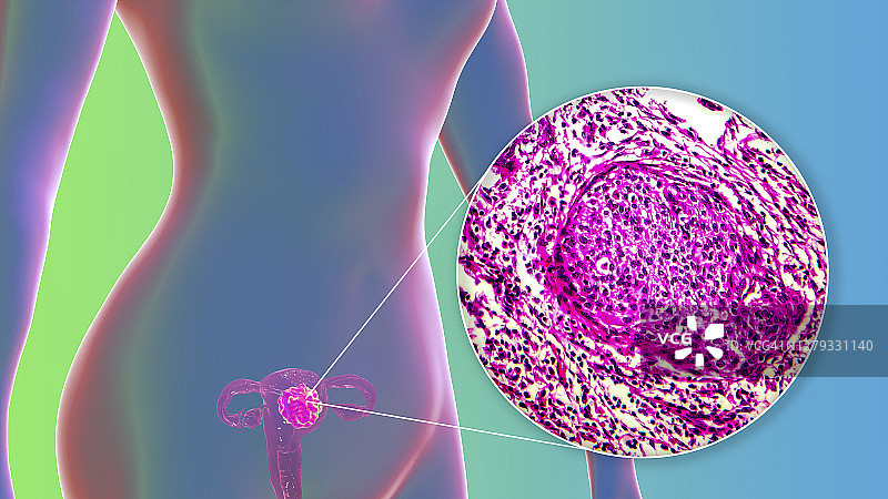 子宫癌，插图和光显微镜图片素材