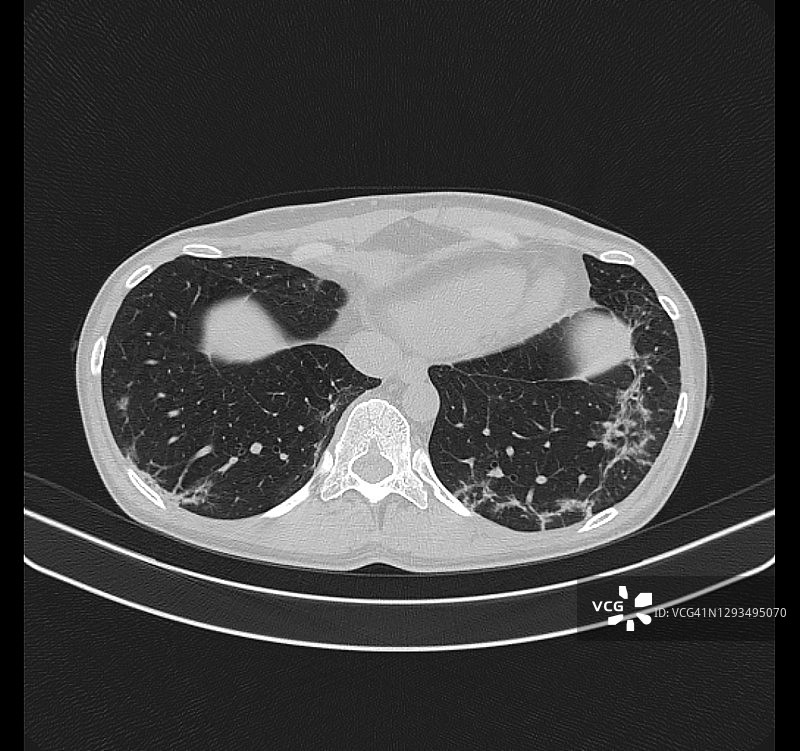 1例COVID-19确诊病例胸部计算机断层扫描图片素材