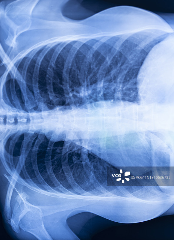 肺肋骨x线扫描结果。图片素材