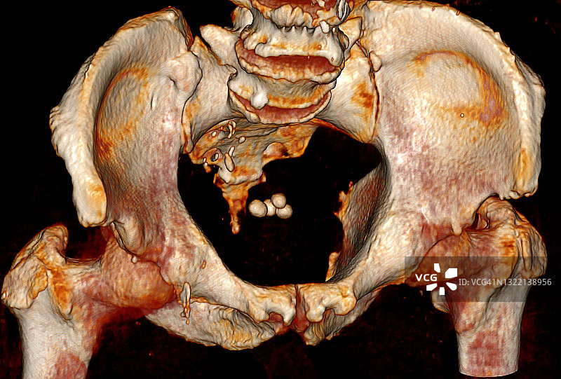 盆腔CT三维重建膀胱结石图片素材