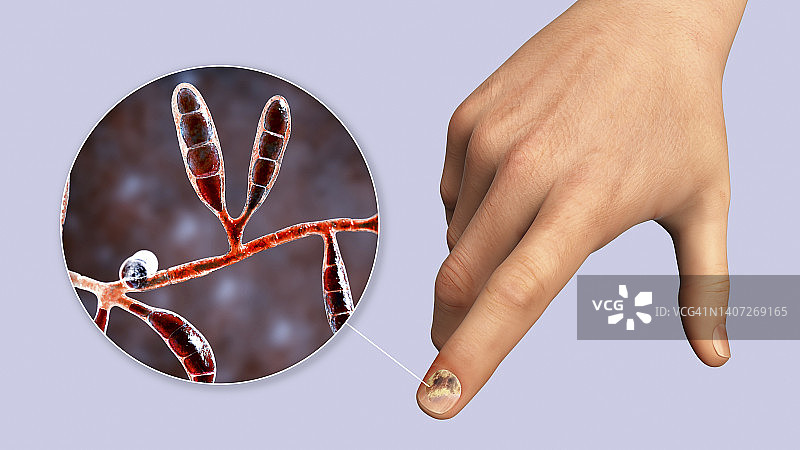 指甲真菌感染，插图图片素材