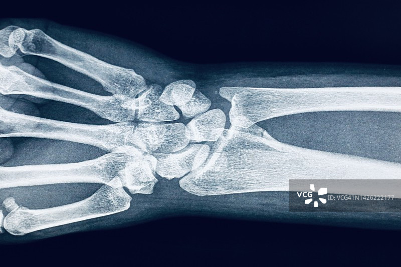人类手腕的x光图像图片素材