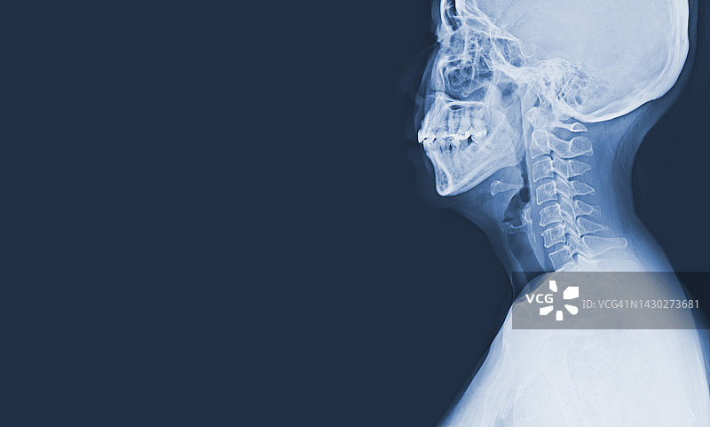 颈椎x线颈椎颈椎5-6处脊髓中度压迫，医学影像概念，复制空间。图片素材