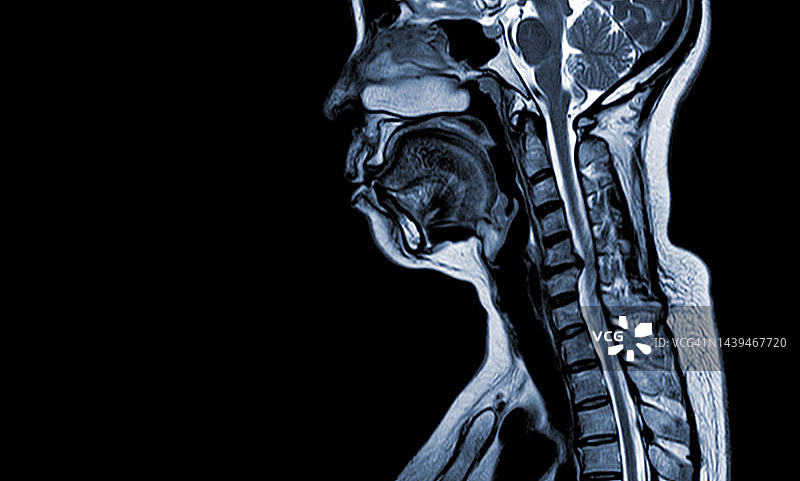 颈椎MRI(1.5特斯拉)矢状位T1W进行颈椎5-6处脊髓中度压迫(AP为6mm)，伴脊髓病。图片素材