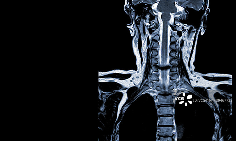 颈椎MRI(1.5特斯拉)通过轴向T2W对C5-6 (AP为6mm)脊髓进行中度压迫。图片素材