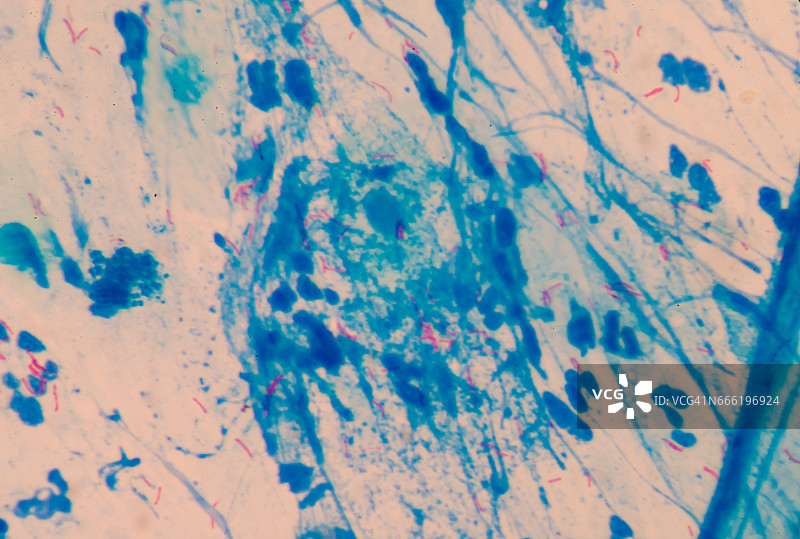 红细胞、微杆菌、结核在蓝色背景医学上。图片素材