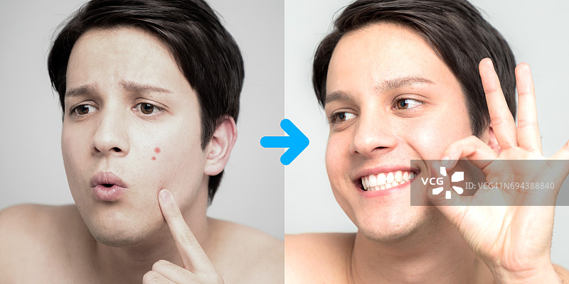 男士青春痘治疗前后形象，青春痘治疗，男士皮肤护理图片素材