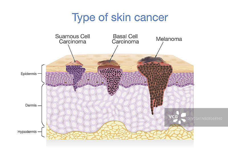 皮肤层有三种类型的癌症。图片素材