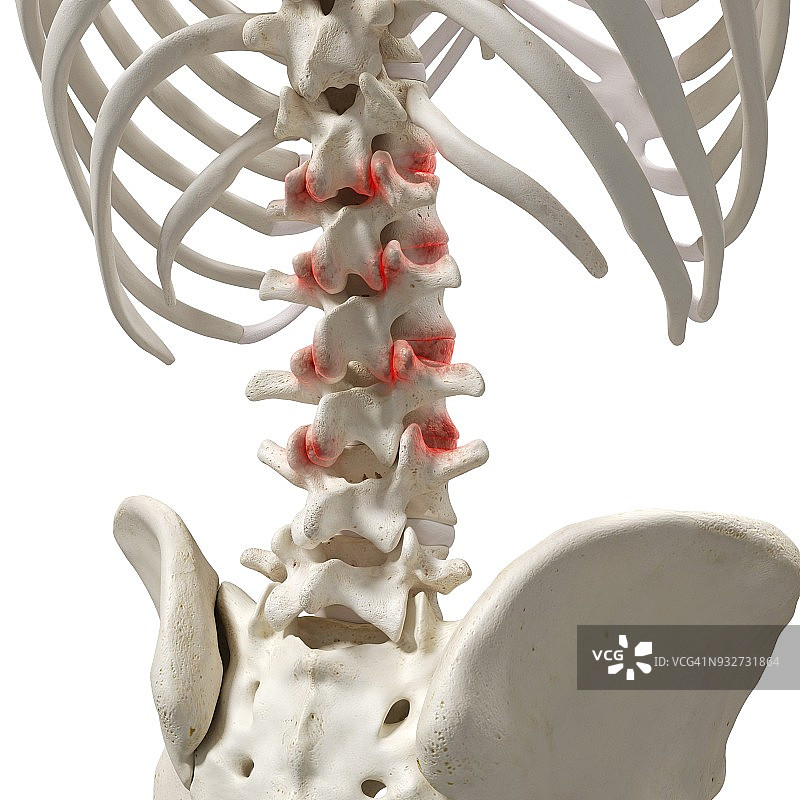 脊柱关节炎，图示图片素材