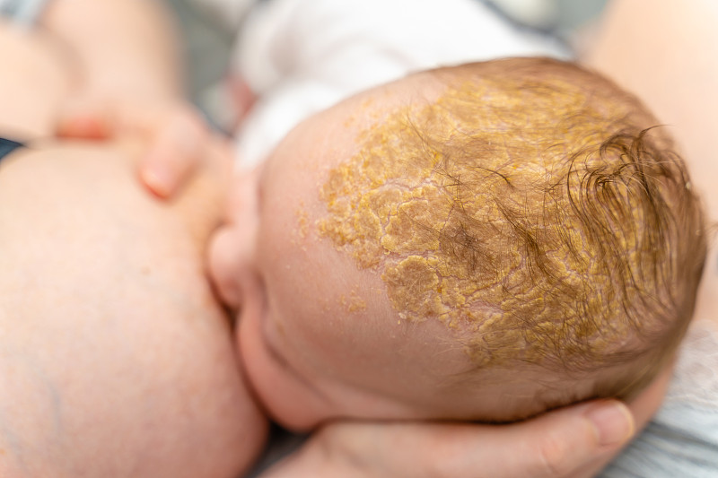 强摇篮帽脂溢性皮炎在婴儿头部头皮哺乳特写图片下载