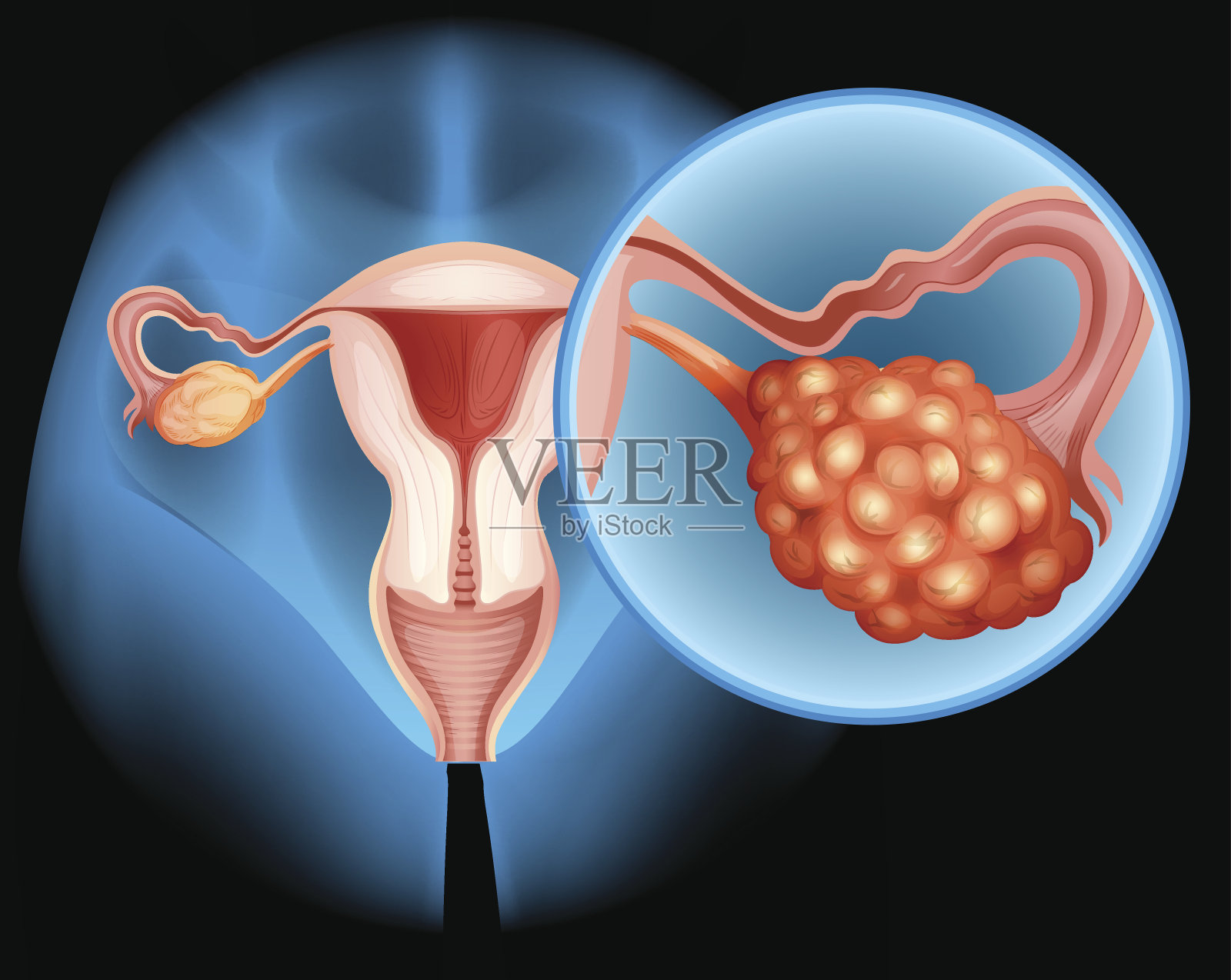 卵巢癌的详细图表插画图片素材