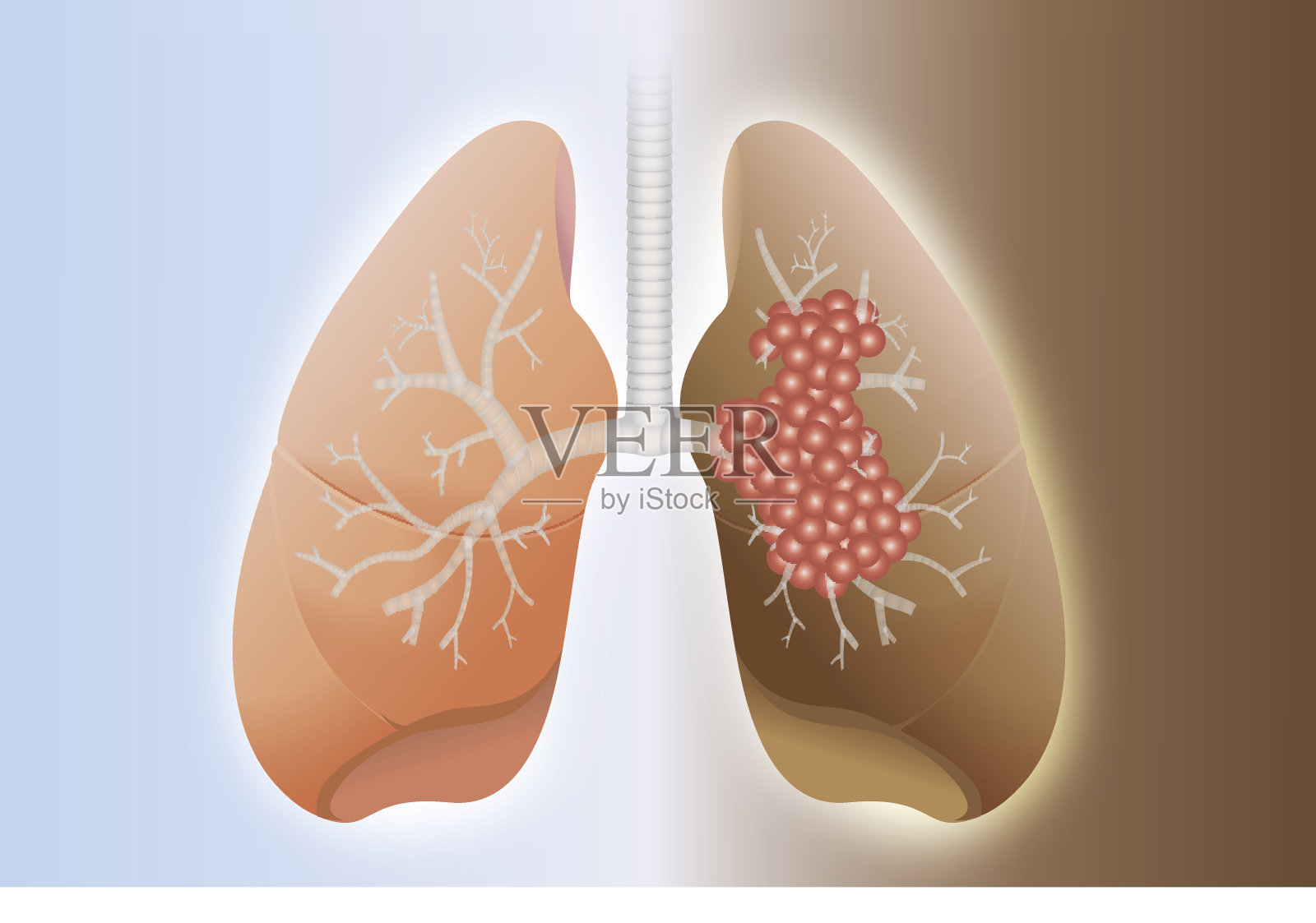 健康的肺和癌症的肺插画图片素材