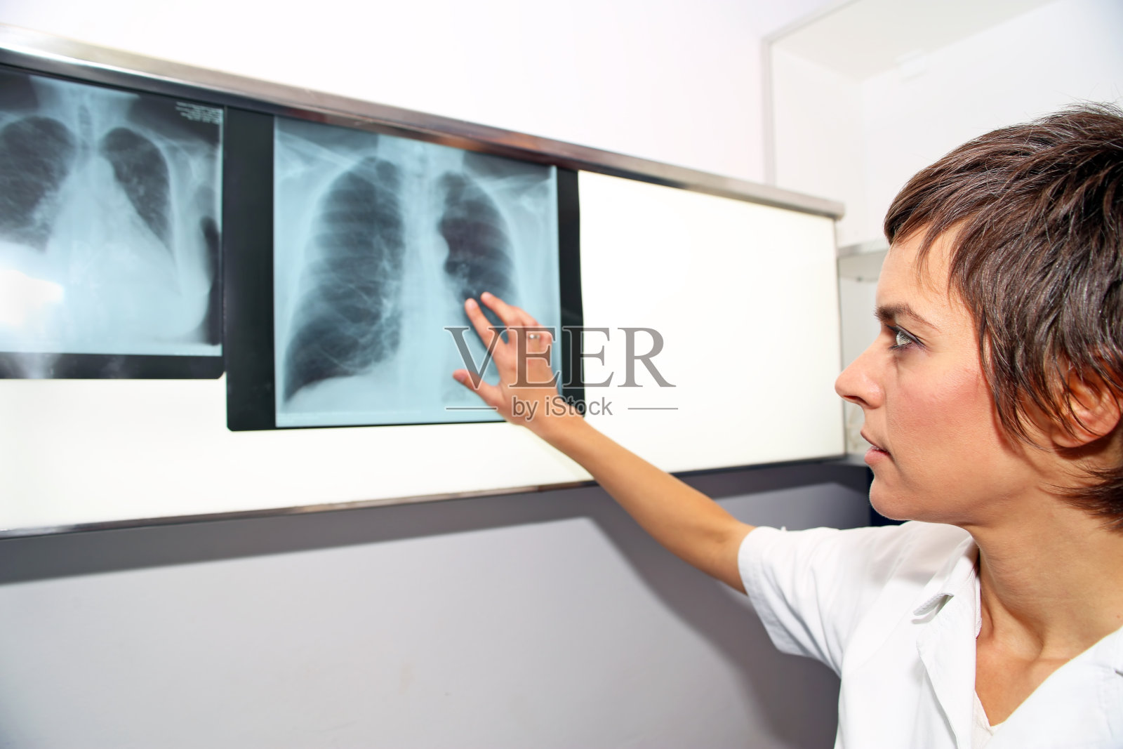 肺x线，肺栓塞，肺动脉高压，慢性肺栓塞照片摄影图片