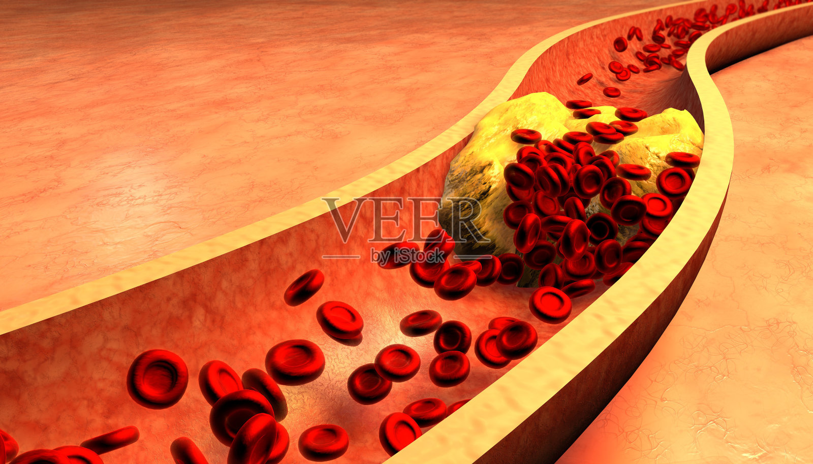 血小板和胆固醇斑块堵塞的动脉照片摄影图片